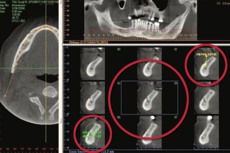 BEI ADENTICS | Endodontologie - Wurzelkanalbehandlung