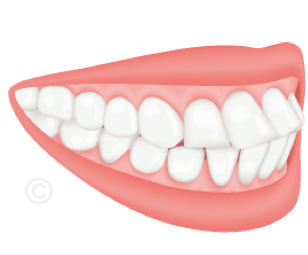 Dysgnathien-Protrusion