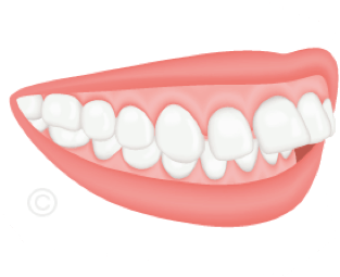 Dysgnathien-Rückbiss