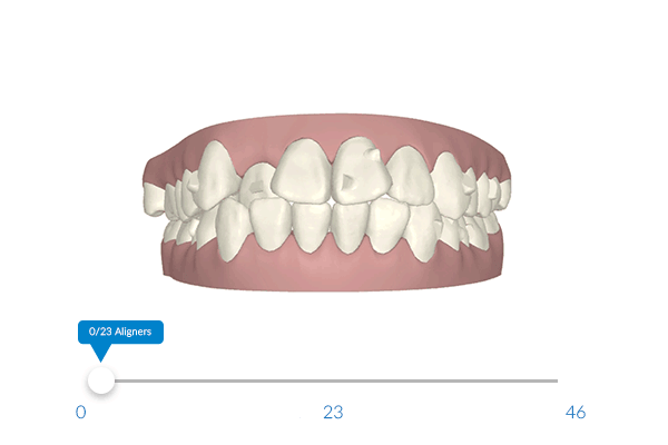 BEI ADENTICS | Invisalign - Schon vorher sehen, wie die Zähne später aussehen werden.
