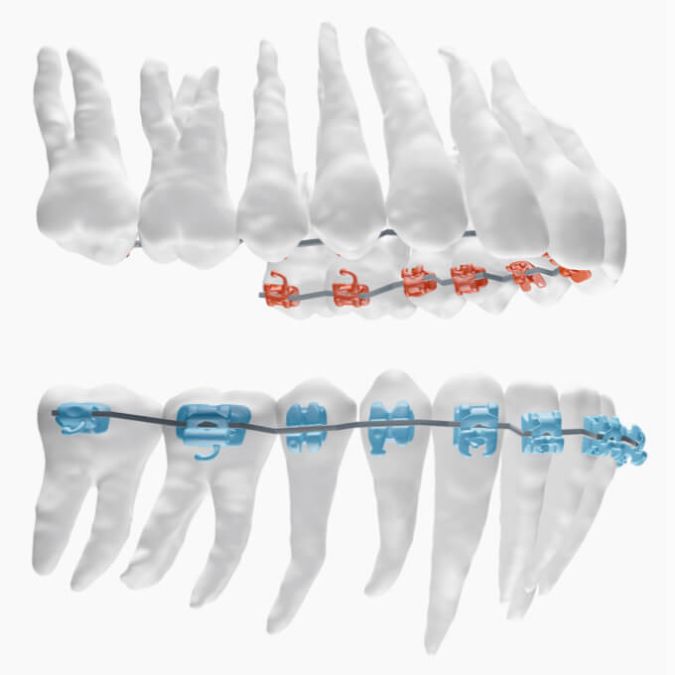 BEI ADENTICS in Berlin| 3. Schritt: 3D-Behandlungsplanung SureSmile® Software Zahnbewegung simuliert und die Drähte werden digital geplant.