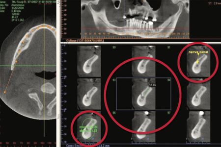 BEI ADENTICS | Endodontologie - Wurzelkanalbehandlung