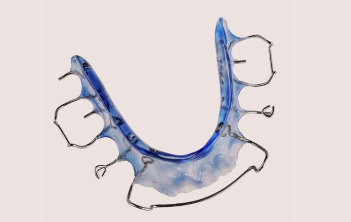  Bei verfrüht Milchzahn ausfall muss ein Lückenhalter/Platzhalter angefertigt werden. Sie hält die Lücke für den noch kommenden bleibenden Zahn offen.