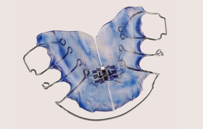  Aktive Platte ist eine herausnehmbare Spange, die Federelemente zur Zahnbewegung oder Schrauben zur Kieferdehnung besitzt.