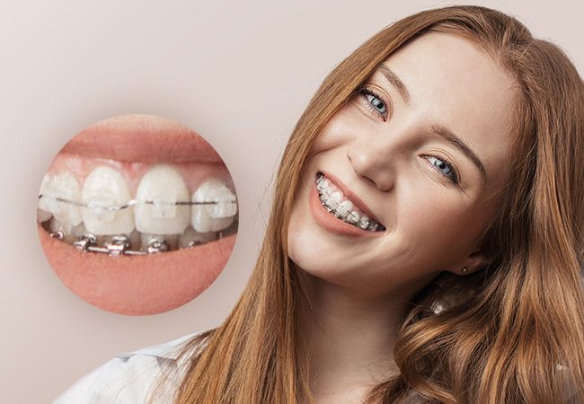 Keramikbrackets können mit BEI ADENTICS in Berlin|Metallbrackets kombiniert werden, um die Kosten zu reduzieren.