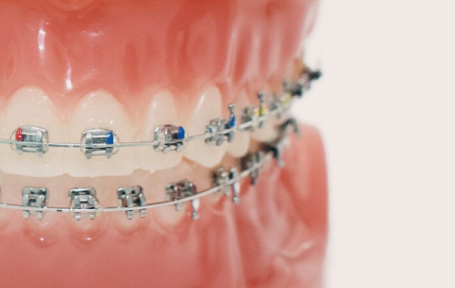 BEI ADENTICS |Metallbrackets: robuste und zuverlässige Ausführung. Minibrackets, die kleinsten Brackets und nickelfreie Brackets für Allergiker