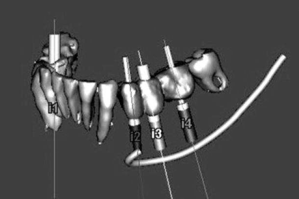 BEI ADENTICS | Implantologie-Einsetzen von Zahnimplantaten 
