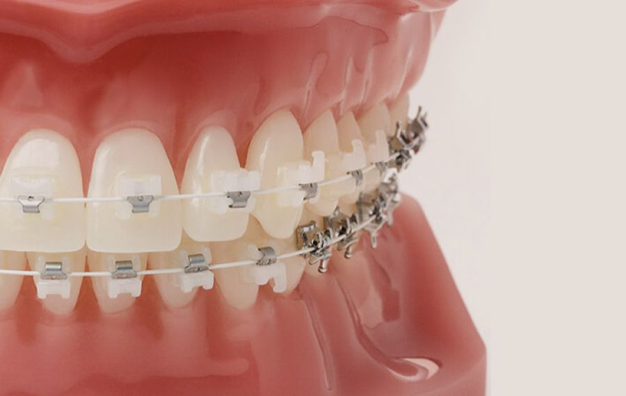 Selbstligierende Brackets benötigen zum Einbinden der Drähte keine zusätzlichen Gummis oder Metallligaturen. Das reduziert die Reibung bei der Zahnbewegung