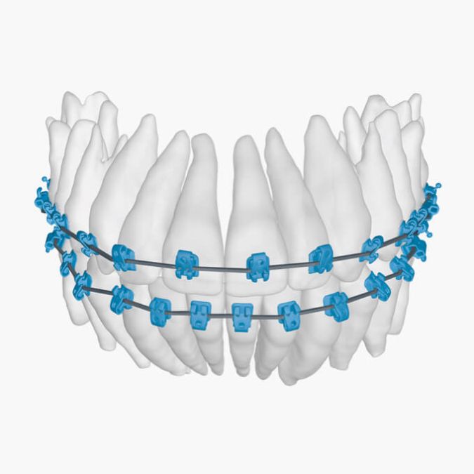 BEI ADENTICS in Berlin| 3. Schritt: 3D-Behandlungsplanung SureSmile® Software Zahnbewegung simuliert und die Drähte werden digital geplant.