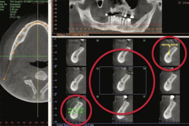 BEI ADENTICS | Endodontologie - Wurzelkanalbehandlung