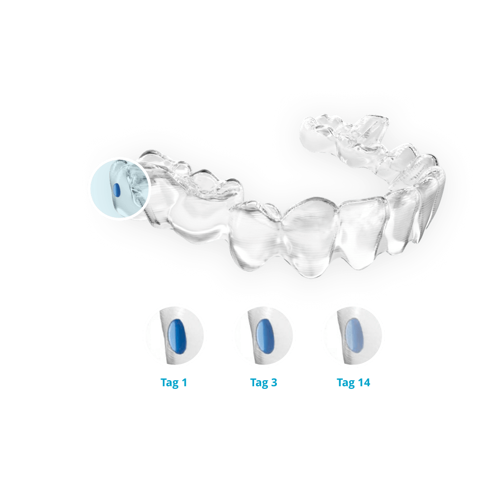 BEI ADENTICS |Invisalign Teen mit Indikatoren, die Tagesdauer anzeigen in Berlin