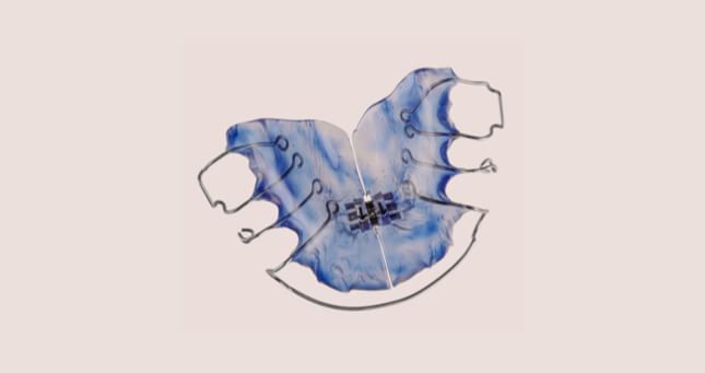 BEI ADENTICS | Lose Zahnspange zur Zahnkorrektur